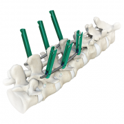 Имплантат MIS Plus Москва