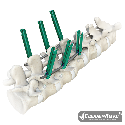 Имплантат MIS Plus Москва - изображение 1