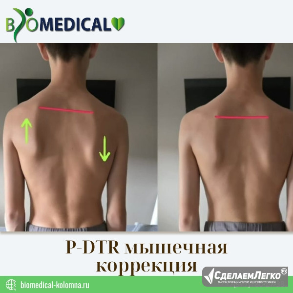 P-DTR мышечная коррекция Коломна - изображение 1